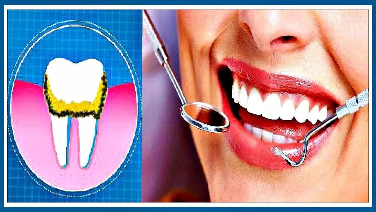 Как удалить зубную в домашних условиях. Чистка зубов в домашних условиях. Отбеливаем зубы зубной камень. Инструменты для поддержания здоровья зубов. Удалить зуб в домашних условиях.