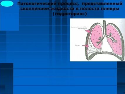 Лечение гидроторакса