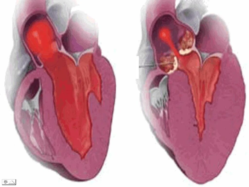 Гипертоническая болезнь и гипертрофия левого желудочка. Компенсаторная гипертрофия левого желудочка. Атрофия левого желудочка сердца опасно. Гипертрофия левого желудочка при хсн. Гипертрофия и дилатация миокарда.