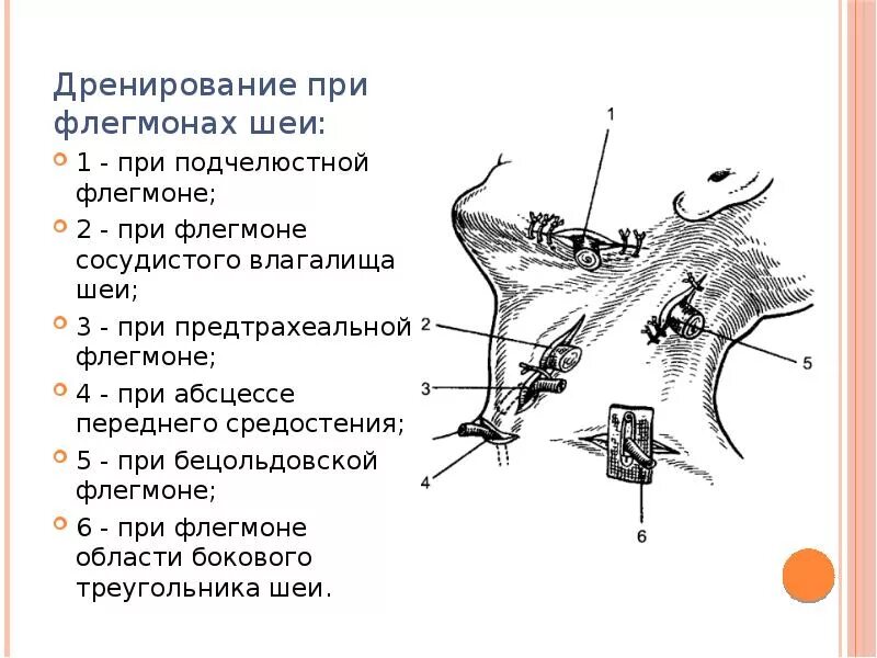 Дренаж при абсцессе
