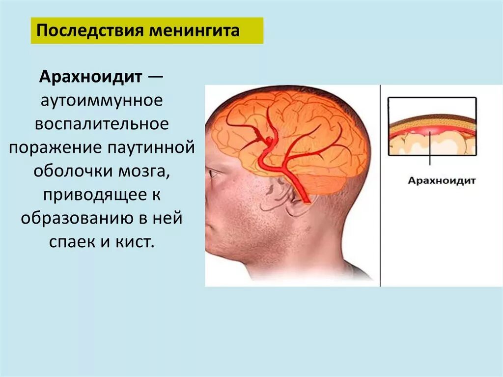 Последствия поражения мозга. Менингит воспаление мозговых оболочек. Очаг поражения менингита. Воспаление головного мозга симптомы менингит.