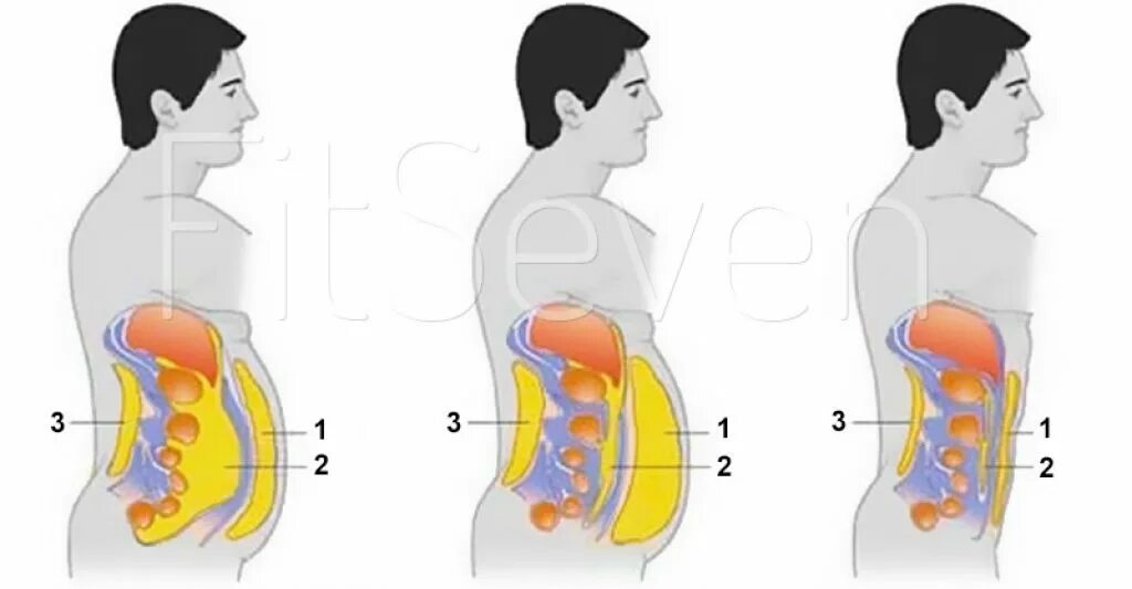 Подкожный и висцеральный жир. Висцеральный жир внутри. Сжигание подкожного