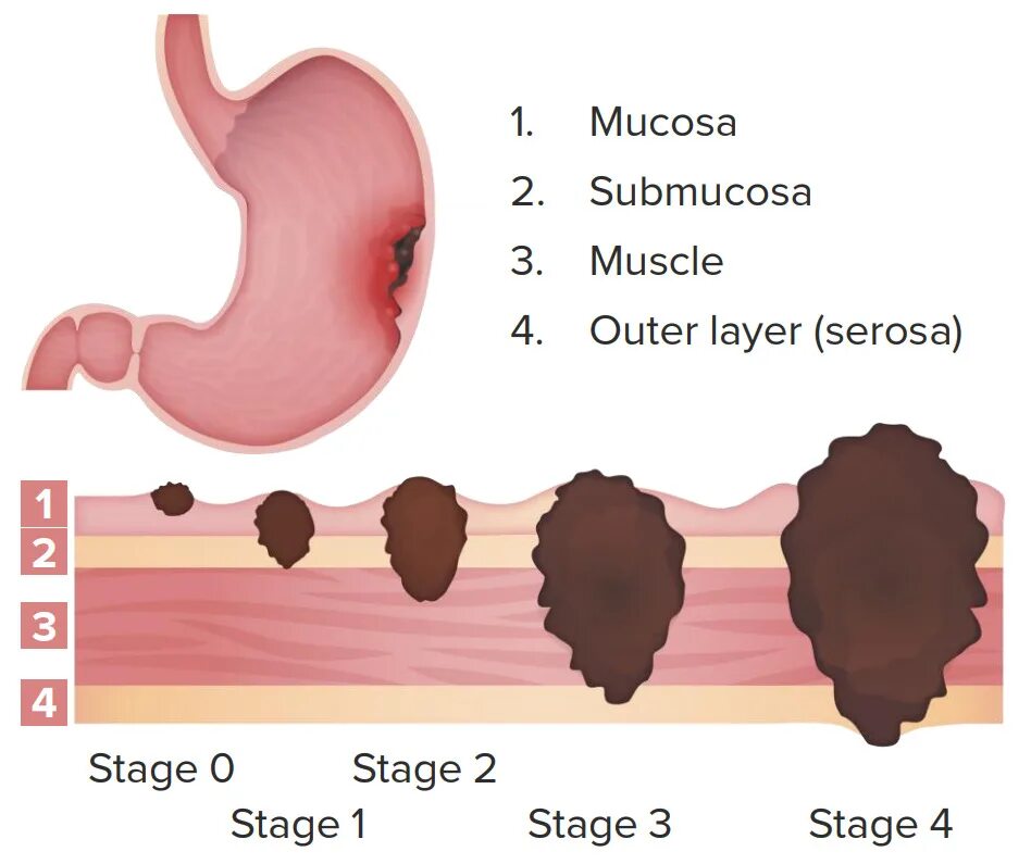 TNM classification in gastric Cancer. Stages of cancer