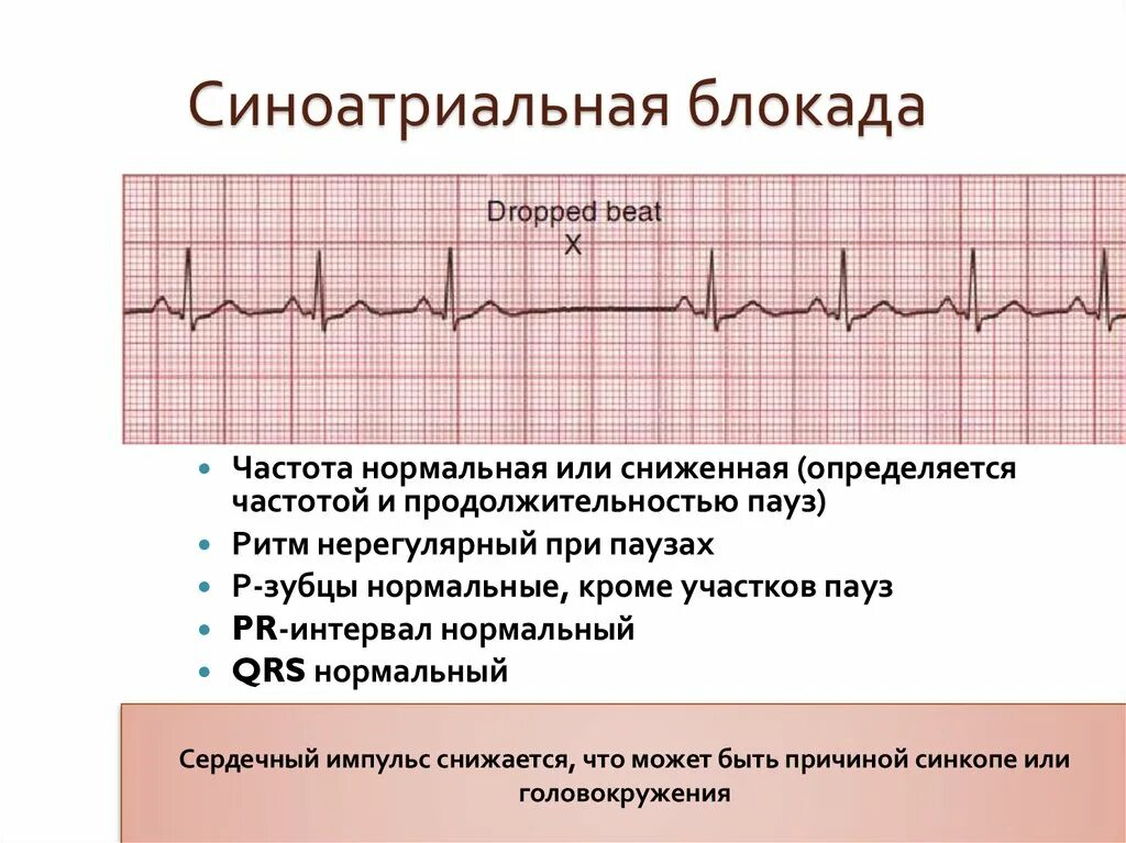 Блокада заболевание. ЭКГ при АВ блокаде 2 степени. Симптомы av блокады 2 степени. Са блокада 2 ЭКГ признаки. Са блокада 1 степени на ЭКГ признаки.