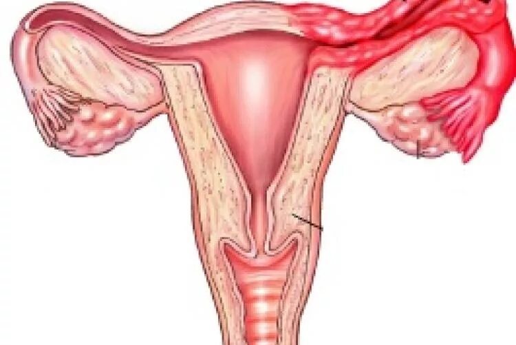Сальпингоофорит (аднексит). Воспаление придатков матки клиника. Придатки матки анатомия. Аднексид