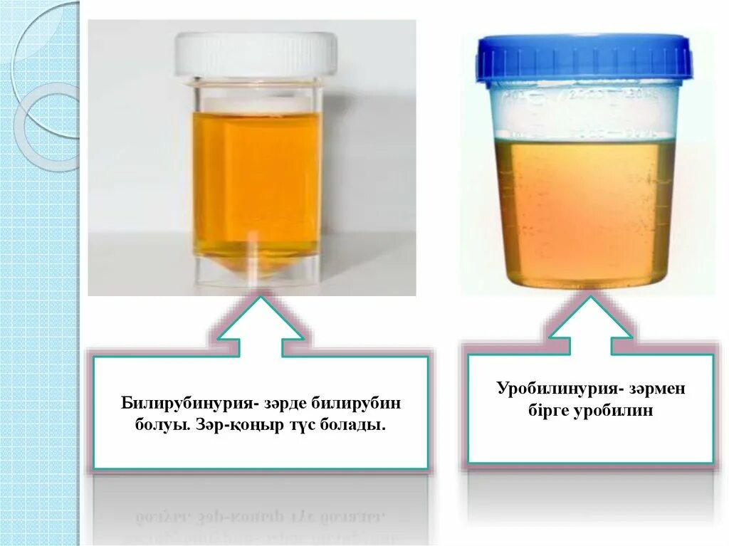 Уробилинурия. Билирубинурия. Билирубин цвет мочи. Цвет мочи при высоком билирубине. Цвет мочи при билирубинурии.