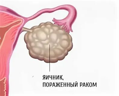 Колит левый яичник