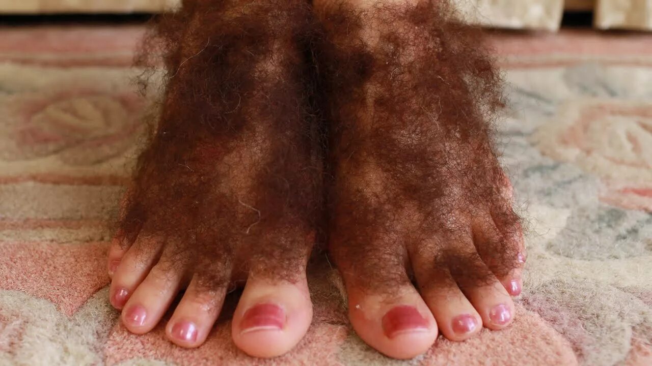 Hairy foot