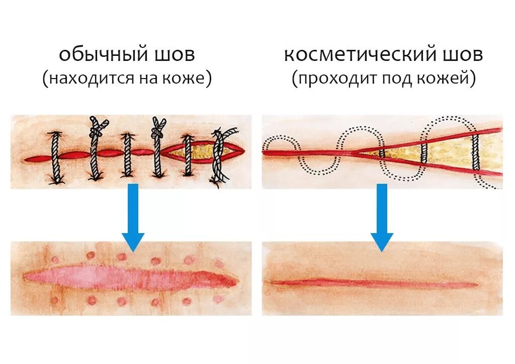 Шов хирургический внутрикожный. Косметический шов кесарева скобы. Косметический шов после операции КС. Косметический шов отличие от хирургического.