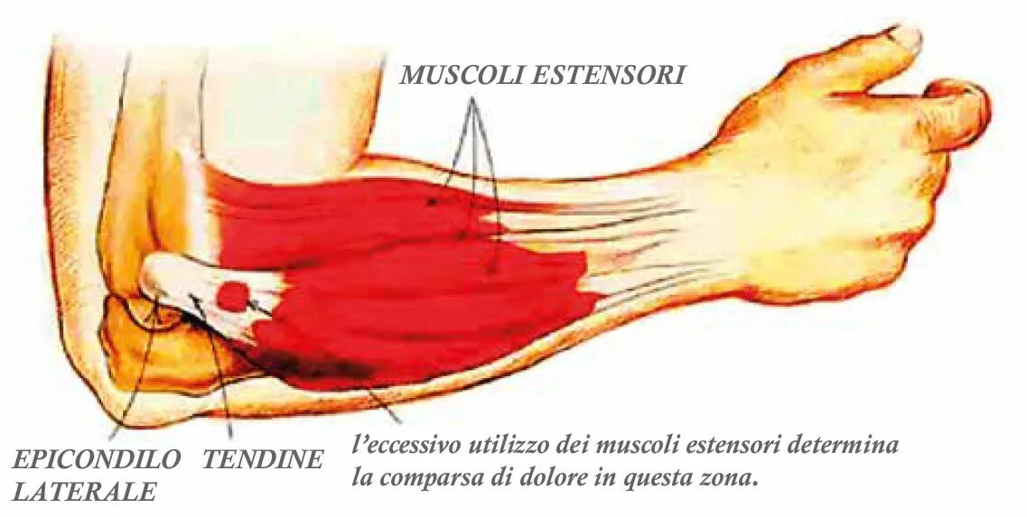 эпикондилит сухожилия. медиальный эпикондилит локтевого. сухожилия локтевого сустава.