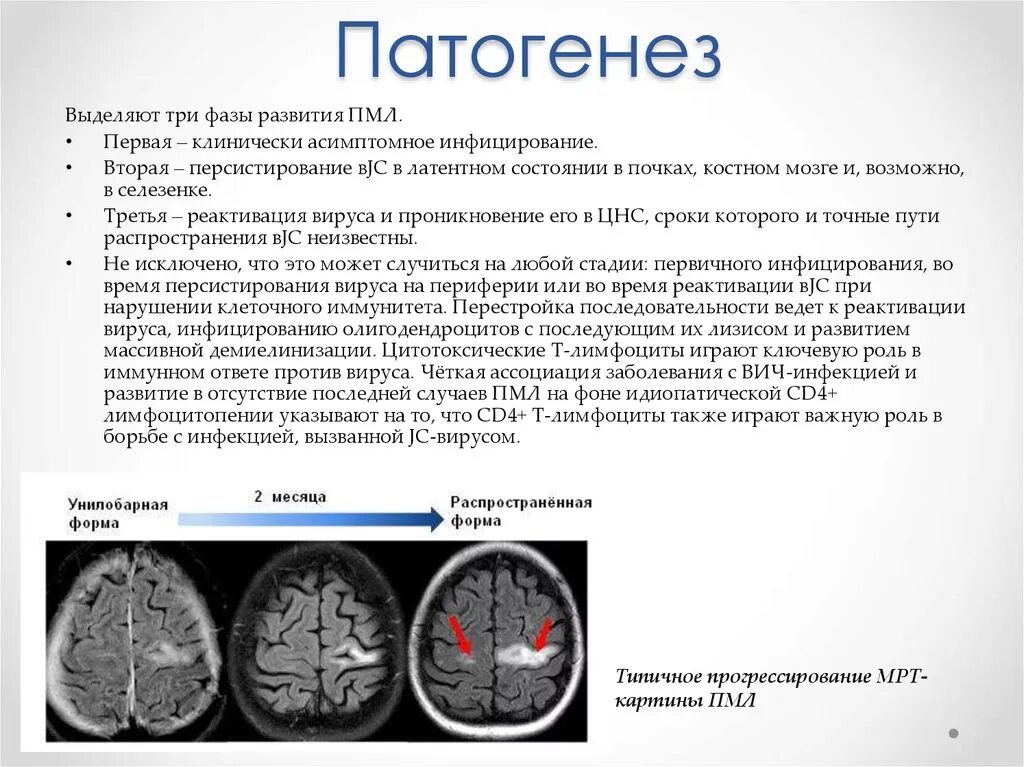 Многоочаговые поражения головного. Прогрессирующая мультифокальная лейкоэнцефалопатия кт. ПМЛ мрт прогрессирующая мультифокальная лейкоэнцефалопатия. Прогрессивная мультифокальная лейкоэнцефалопатия. Мультифокальная лейкоэнцефалопатия мрт.