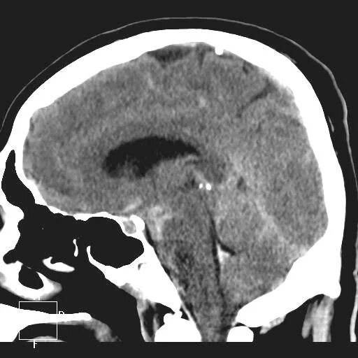 Кровоизлияние ствола мозга. Субарахноидальное кровоизлияние головного мозга на кт. Субарахноидальный инсульт кт. Субарахноидальное кровоизлияние МСКТ. Перимезенцефальное кровоизлияние кт.