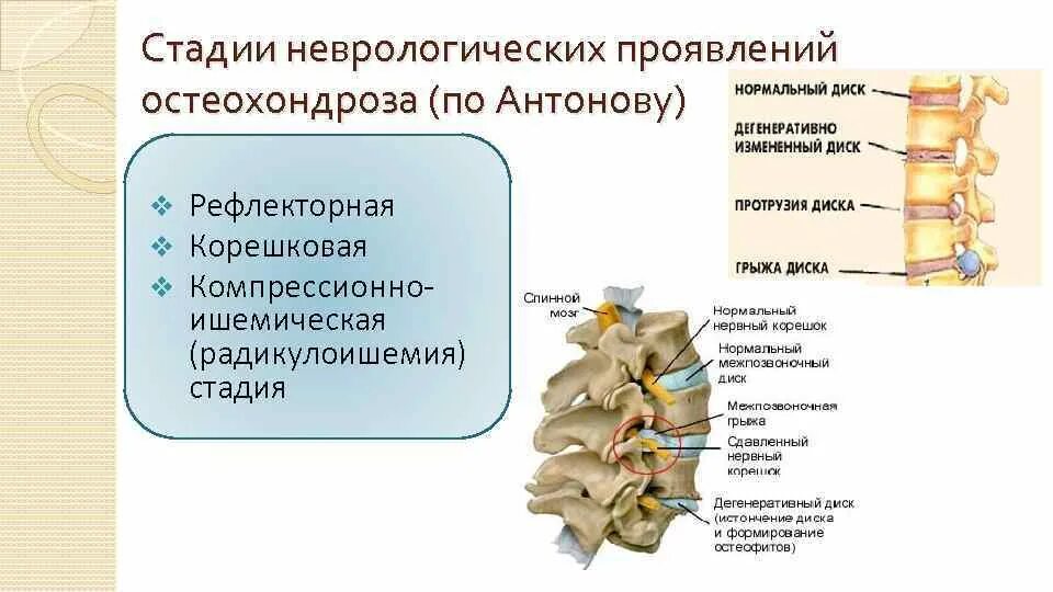 Корешковые нервы в пояснице. Корешковый синдром шейного отдела с4. Корешковый синдром поясничного отдела позвоночника. Шейный остеохондроз корешковый синдром. Корешковый синдром грудного отдела.