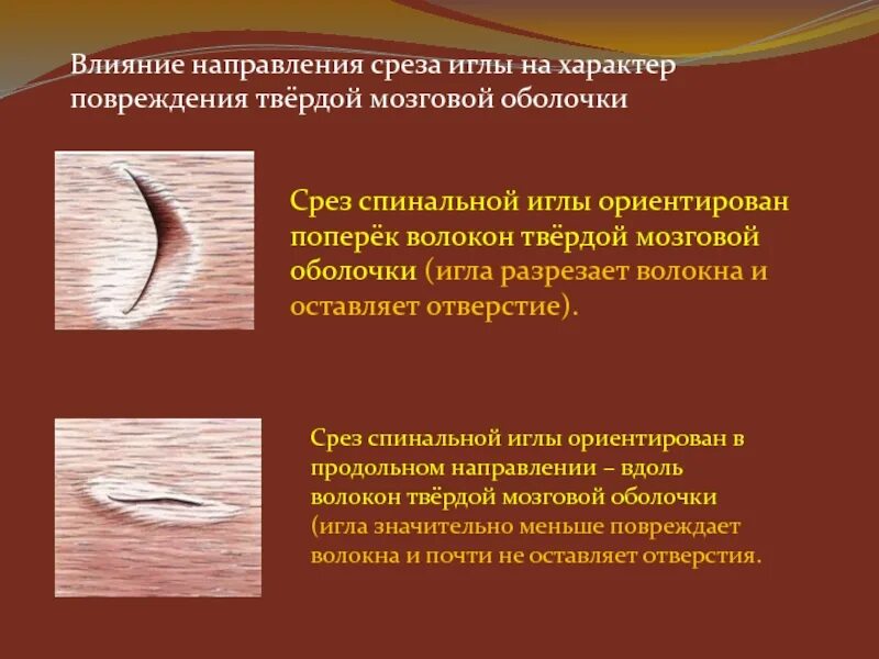 Срезы игл для спинальной анестезии. Типы игл для спинальной анестезии. Иглы для спинномозговой анестезии. Септопластика перегородки носа. 5х103 мм) с проводником.