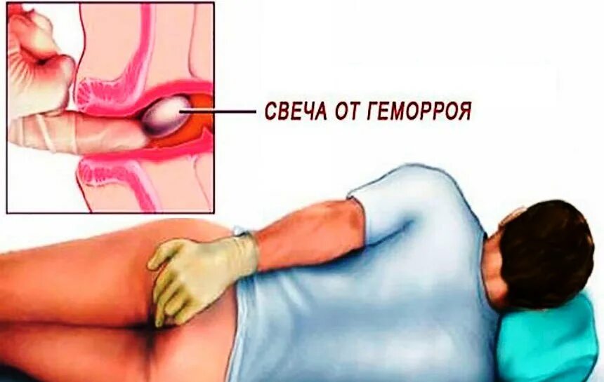 Воспаление внешнего геморройного узла. Геморрой свечи.