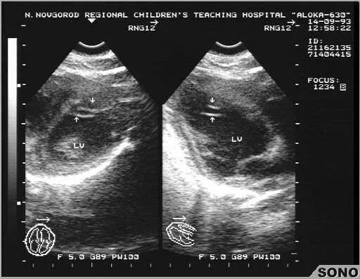 диагональная трабекула в полости