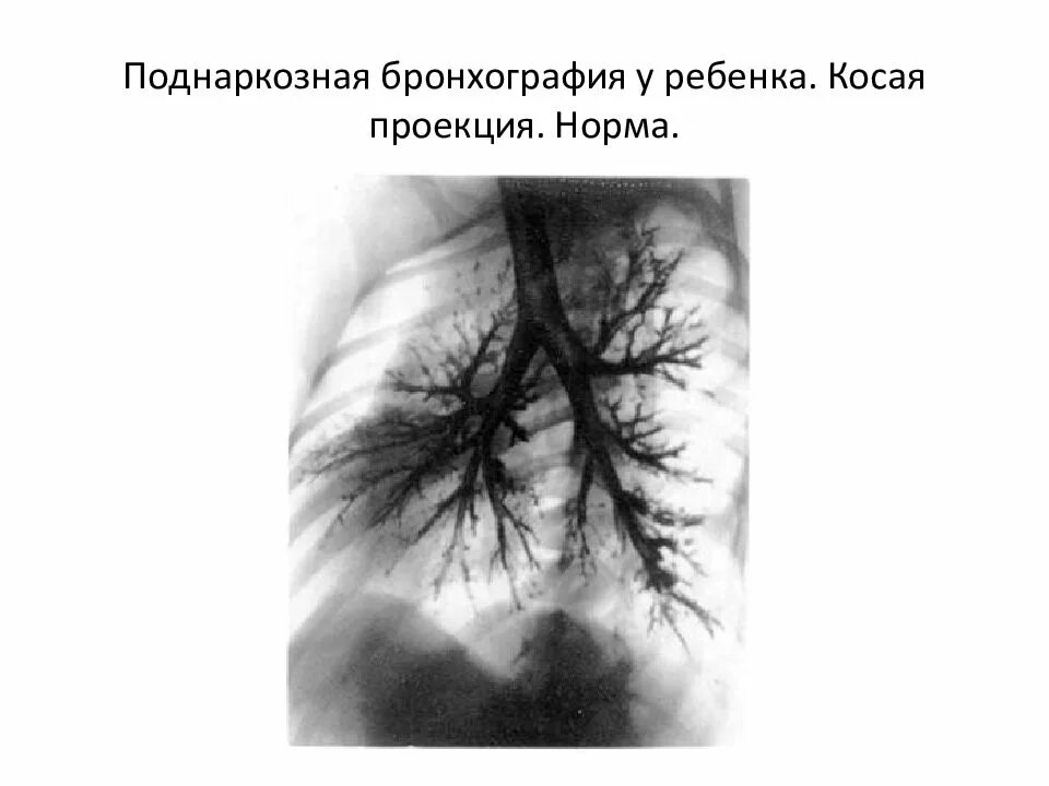 Контрастная бронхография. Воздушная бронхография. Бронхограмма методика. Бронхоскопия и бронхография. Воздушная бронхография.