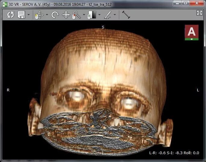 Реконструкция кт изображений. Томография 3д программа. Компьютерная томография, 3d-реконструкция. Трехмерная реконструкция мрт.