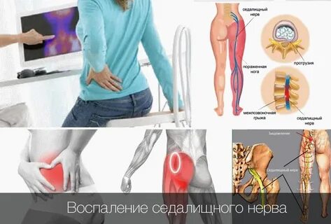 Ишиалгия что