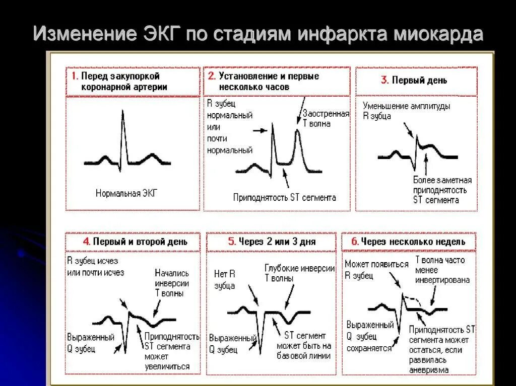 Варианты острого инфаркта миокарда