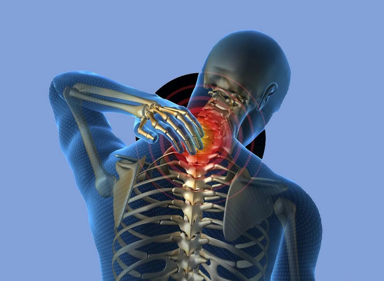 Хондроз шейного отдела позвоночника симптомы. Протрузия шейного отдела позвоночника. Хондроз с4-с5. Протрузия шейного отдела позвоночника с3 - с5. Хондроз шейного отдела с4-с6.