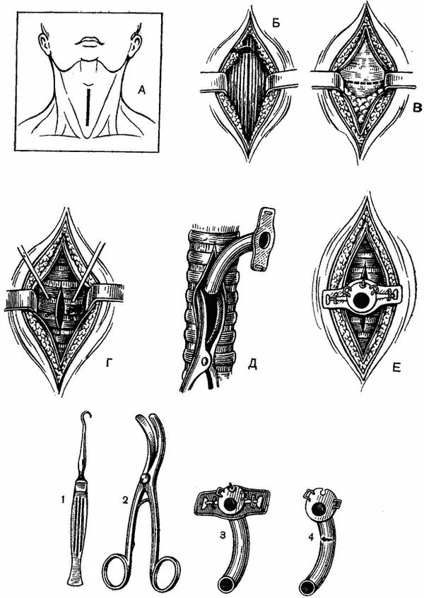 трахеотомия как делать. верхняя трахеостомия оперативная хирургия. трахеостомия трубка дыхательная. нижняя трахеотомия у детей. трахеостомия и коникотомия.