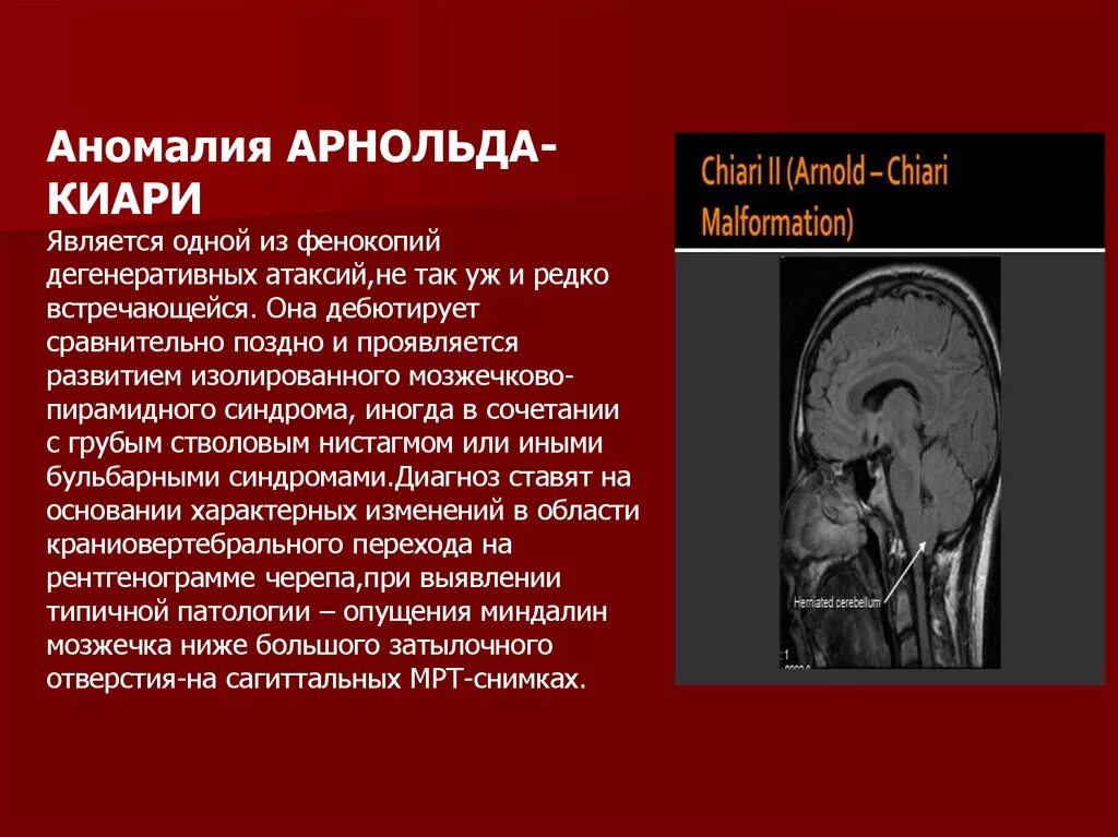 Аномалия Арнольда-Киари болезни. Признаки синдрома Арнольда Киари 1 степени у детей. Операция при Арнольда Киари 1 степени. Мальформация Арнольда-Киари 2 типа.