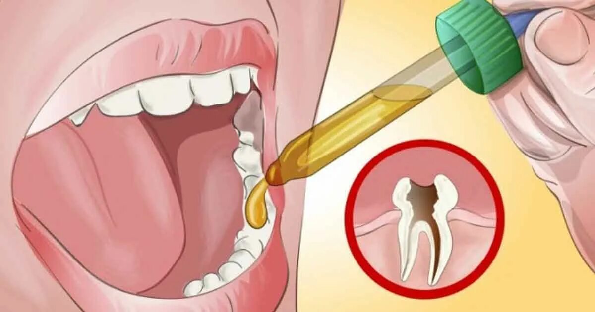 Что можно сделать если сильно. Избавление от зубной боли. Воспаление полости рта и десен.