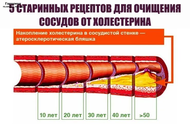 Какое лекарство от бляшек. Лекарство от бляшек для очистки сосудов. сосуды при атеросклерозе. атеросклероз чистка сосудов.