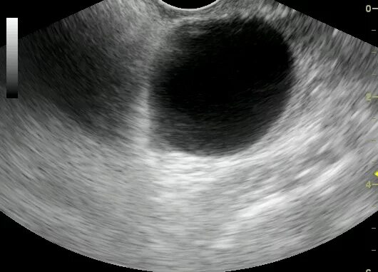 Пустое плодное яйцо на УЗИ. УЗИ анэмбриония 5 недель. Анэмбриония – пустое плодное яйцо. Плодное яйцо на УЗИ на ранних сроках 2 недели. Без плодного яйца