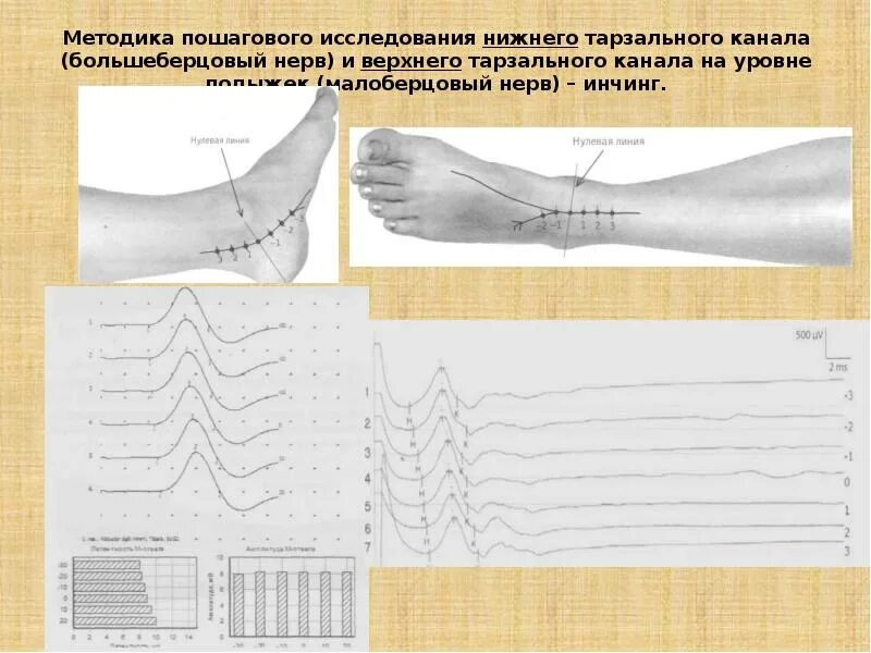 Тарзальный канал. Тарзальный канал большеберцового нерва. анатомия тарзального канала. синдром тарзального канала. нижний тарзальный канал.