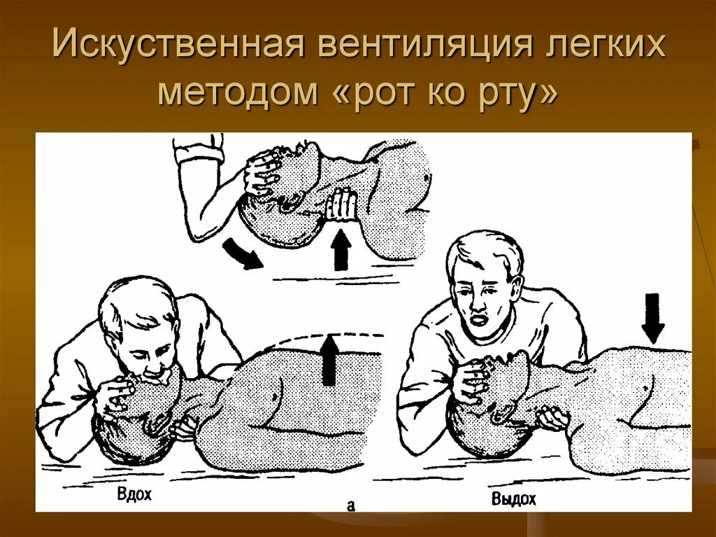 Типов искусственной вентиляции легких. Искусственная вентиляция легких (ивл). искусственная вентиляция легких алгоритм.