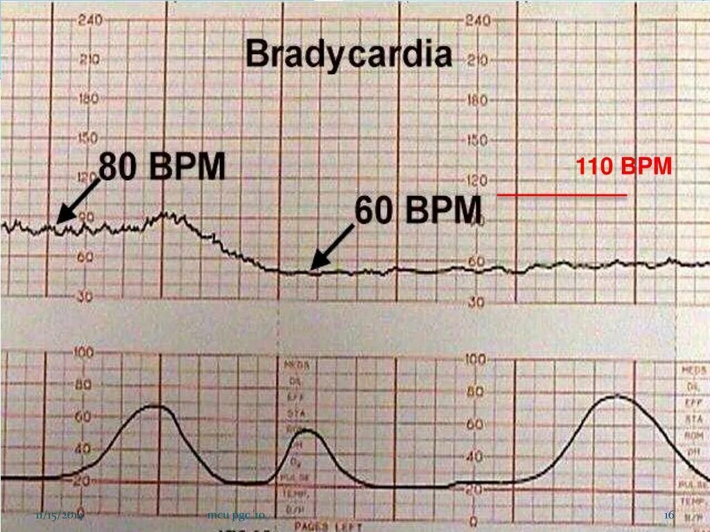 Брадикардия плода КТГ. Причины тахикардии у плода на КТГ. Тахикардия на КТГ У плода. КТГ плода при брадикардии.