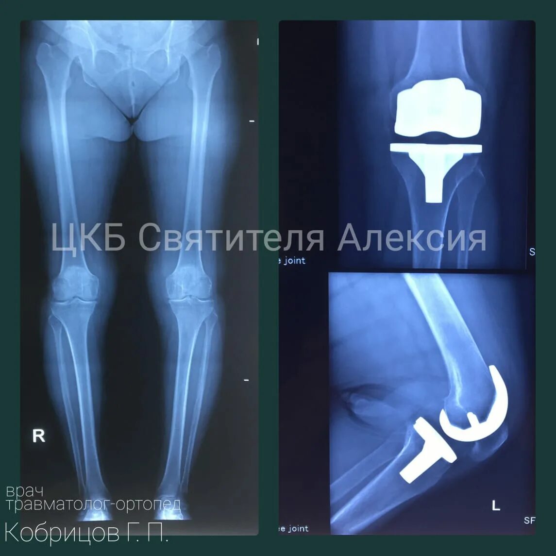 Отзывы после эндопротезирования. Эндопротезирование коленного сустава. Двустороннее эндопротезирование коленных суставов рентген. Эндопротезирование коленных судов. Эндопротезирование коленного сустава пожилым.