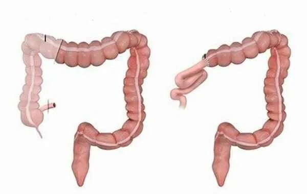 Гемиколэктомия ободочной кишки. Гемиколэктомия кишечника. Левосторонняя гемиколэктомия. Правосторонняя гемиколэктомия. Колэктомия это