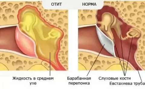 Через сколько проходит отита заложенность