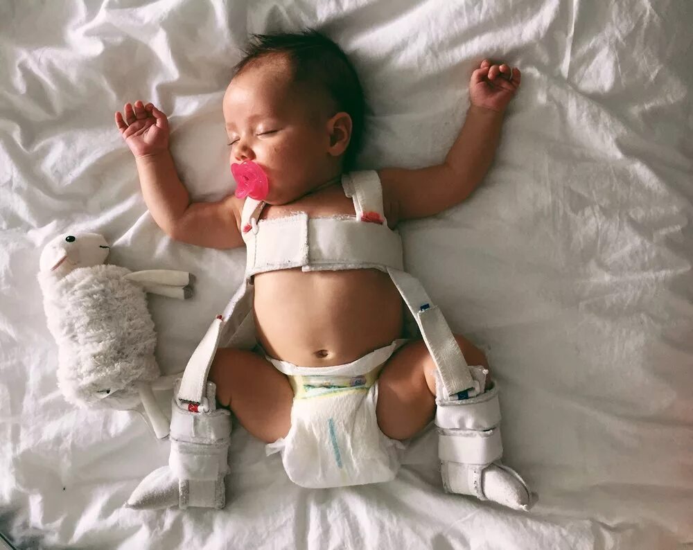 Вывихи у младенцев. Вывихи у младенцев. Дисплазия тазобедренных суставов у новорожденных 1б. Врожденный вывих бедра (дисплазия бедра). Ограничение отведения бедра у младенца.