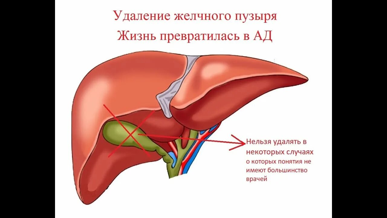 Что будет если удалить желчный пузырь. Удаленный желчный пузырь. Удаленный желчный пузырь последствия. Удаление желчного пузыря осложнения. Отключенный желчный пузырь.