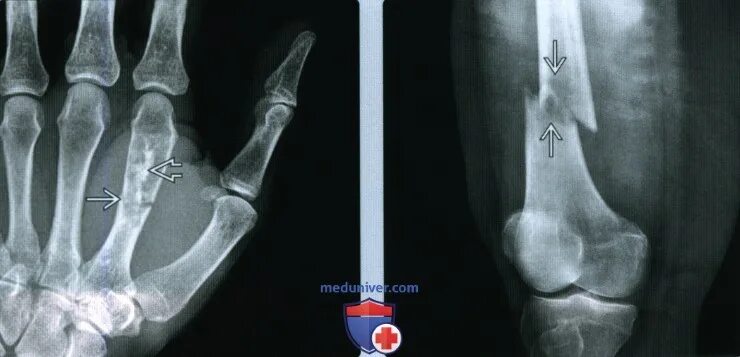 Энхондрома фаланги рентген. Энхондрома фаланги пальца. Энхондрома кости пальца. Энхондрома пястных костей.