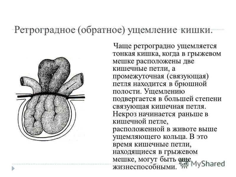 Ретроградное ущемление. Ретроградное ущемление петель тонкой кишки. Пристеночное ущемление (грыжа рихтера). Ретроградное ущемление тонкой кишки. Ретроградное ущемление кишки.