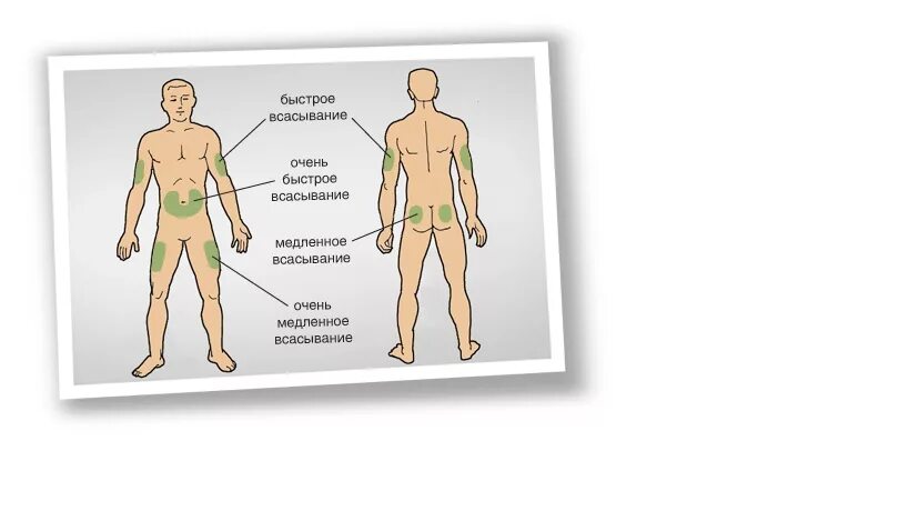 Куда колоть инсулин при диабете. Места для инъекции инсулина схема. Места для инъекции инсулина схема. Участки тела для введения инсулина. Места инъекций инсулина.