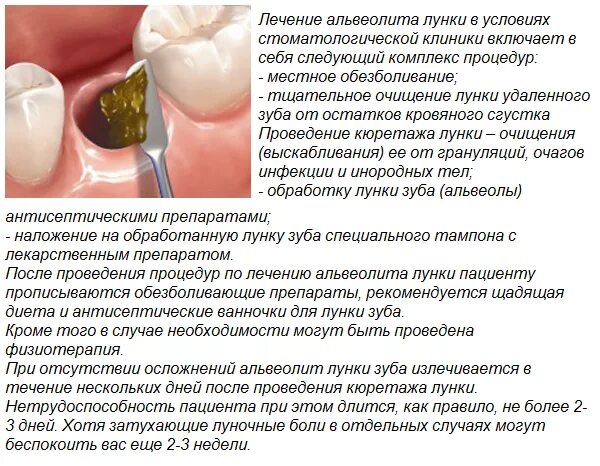 Полоскание после удаления зуба мудрости