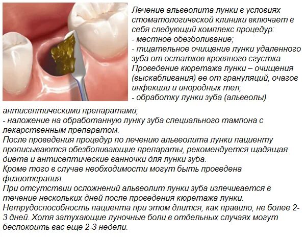 Альвеолит воспаление лунки. Гипертрофический альвеолит. Заживление удаленного зуба.