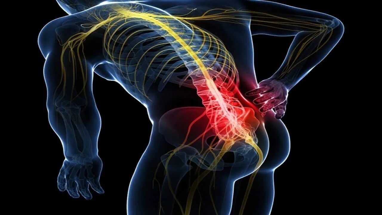 Бьется нерв. Седалищный нерв (sciatic nerve)? 011. люмбоишиалгия поясничного отдела позвоночника. плексит пояснично крестцового отдела. радикулит седалищный нерв в пояснице.