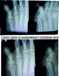 Сколько заживает перелом пальца
