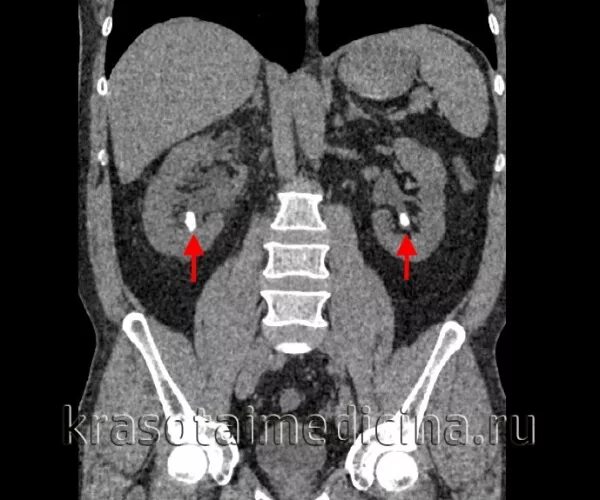 Камни на кт видны. Кт при камнях в почках и мочеточнике.