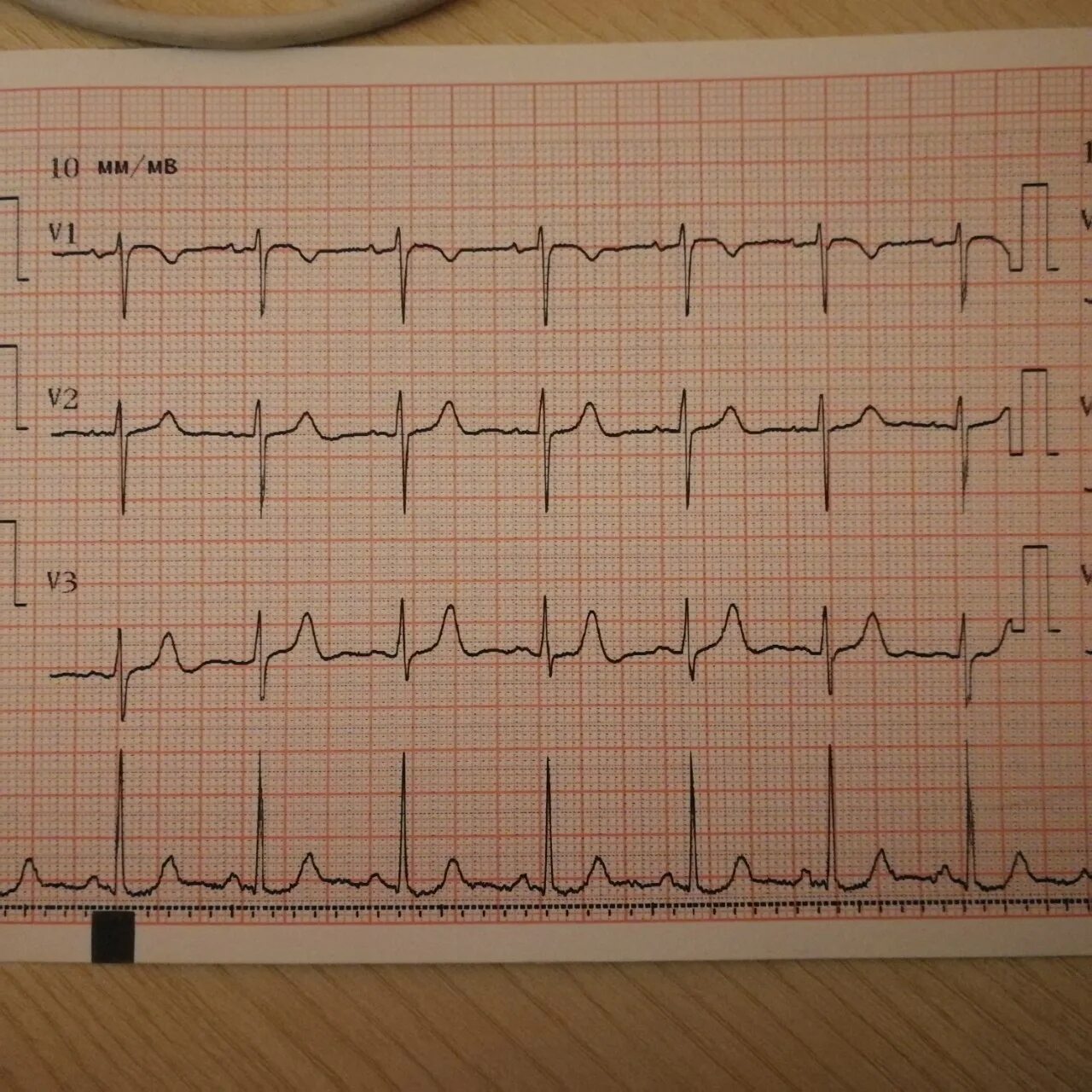 ЭКГ электрокардиограмма сердца. Нормальная кардиограмма здорового человека. ЭКГ 2022. ЭГГ здорового человека. Экг сочи
