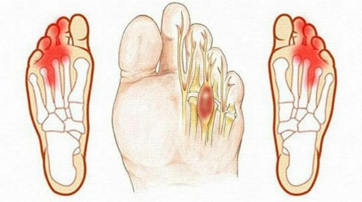Синдром Мортона неврома. Подошвенная неврома Мортона. Неврома Мортона операция. Болит подошва при ходьбе