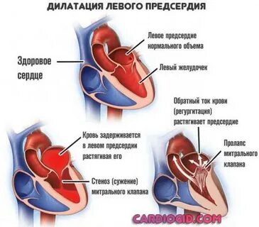 Дилатация левого желудочка и правого желудочка