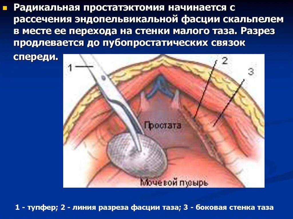 Простатэктомия простаты